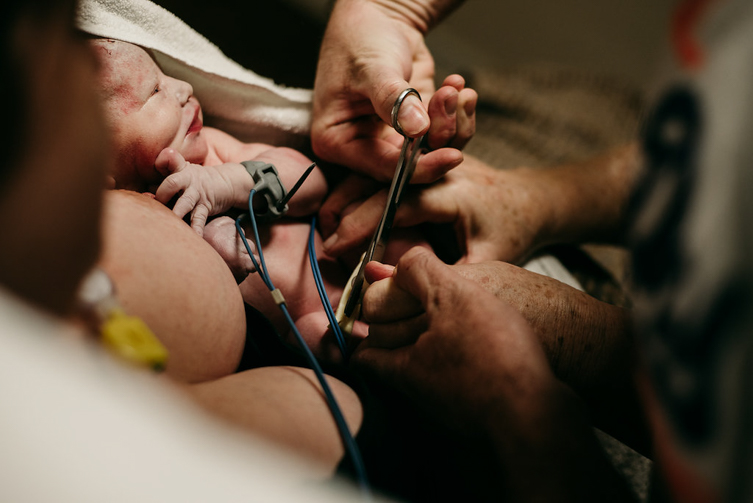 cutting umbilical cord of newborn baby