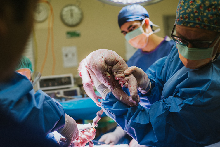 c-section photos of newborn baby