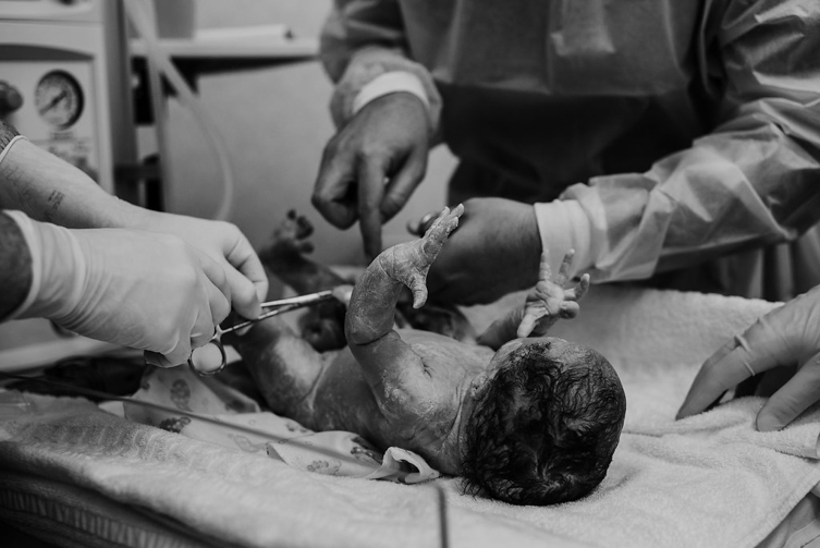  doctor cutting newborn baby’s umbilical cord